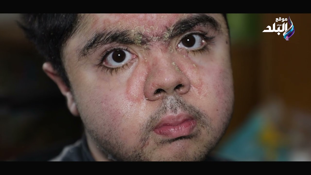 محمود عزت يعاني من مرض ضمور العضلات دوشين يحتاج ل أربعة وعشرين مليون للعلاج