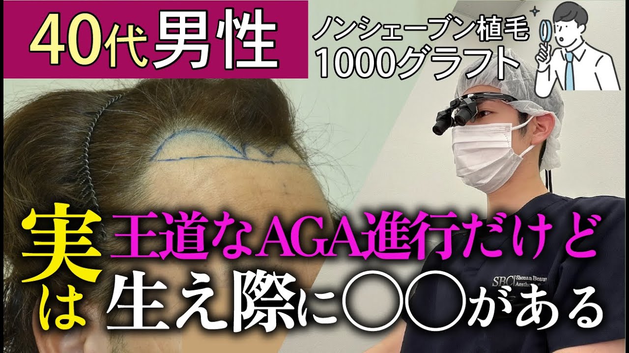 【自毛植毛症例解説】生え際の毛流れが特殊な症例