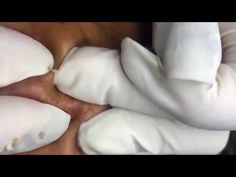 Cystic Acne, Pimples Blackheads, Whiteheads Extraction Acne Treatment Part 