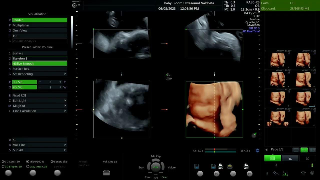 Baby bloom ultrasound studios live stream youtube