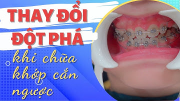 Niềng Răng Chữa Lệch Mặt Và Khớp Cắn Ngược Như Thế Nào? | Nha khoa Đặng Xá - S-Dental