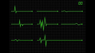 HOW A HEART BEAT FLAT LINE LOOKS LIKE. || ECG flat line