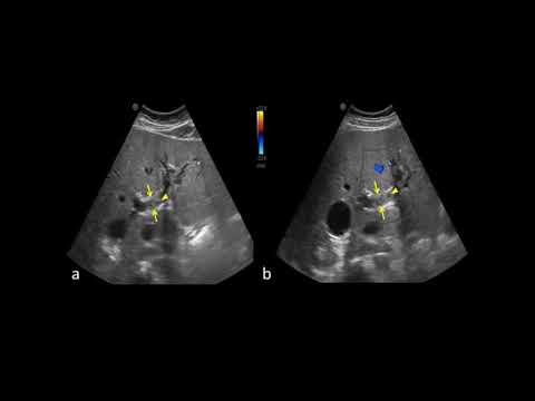 TROMBOSIS DE LA VENA PORTA ASPECTOS ECOGRÁFICOS, ECOGRAFÍA DE HÍGADO.