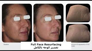 Fractional Laser .. Better freshness and rejuvenated skin