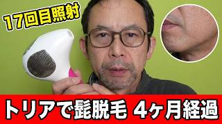 トリアを使用し始めて約４か月経過。髭の様子を確認し１７回目の照射をする