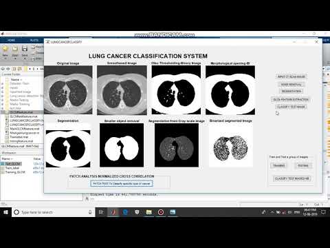 G17_DETECTION OF LUNG CANCER STAGES BY USING VARIOUUS IMAGE PROCESSING TECHNIQUES Part-3