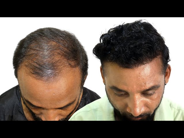FUE - Hair Transplant Result 2019, New Roots Hair Clinic, Grade 4A ; 3650  Grafts Single session