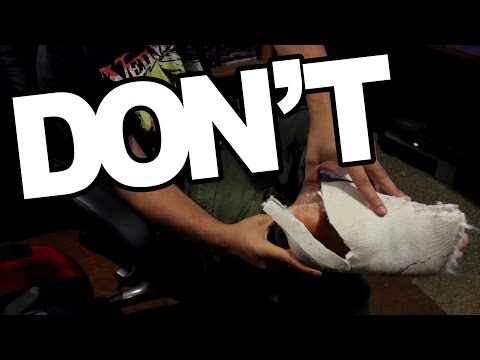 Things You Should NEVER Do: Home Cast Removal!