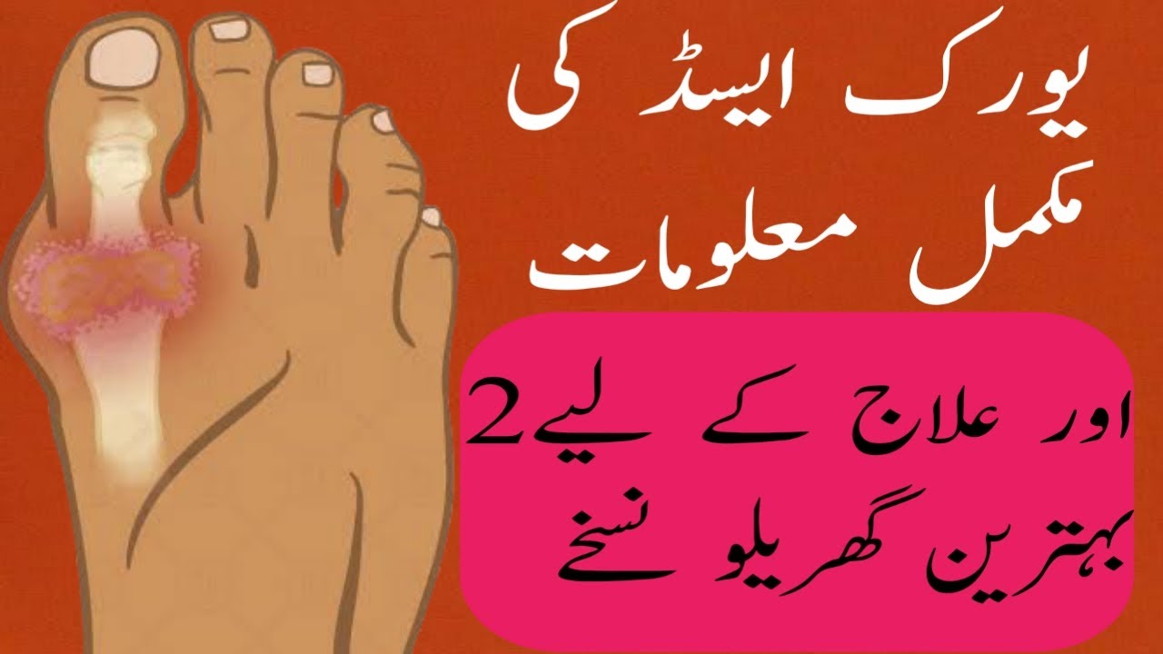 Uric Acid treatment in urdu | Uric acid ka ilaj | Control uric acid
