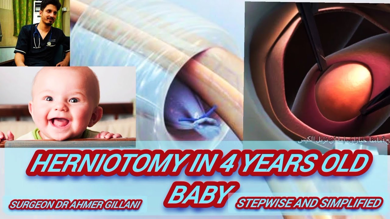 Herniotomy In 4 Years Old Baby/Stepwise and Simplified With embryology
