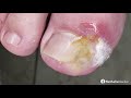 ONICOCRIPTOSE  COM GRANULOMA POR TRAUMA | Objeto pesado caiu no dedo