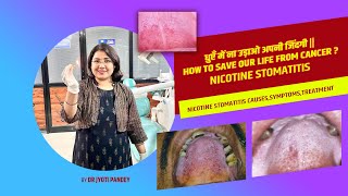धुएँ में ना उड़ाओ अपनी जिंदगी ||Nicotine stomatitis, smoker’s palate.How to save our life from Cancer