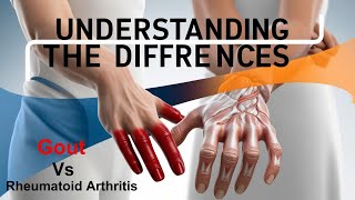 Gout Vs Rheumatoid Arthritis  Understanding the Differences