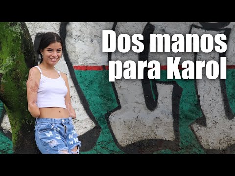 Dos manos biónicas para Karol, la deportista que sufrió la amputación de sus extremidades