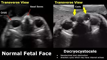 Fetal Face Ultrasound Normal Vs Abnormal Image Appearances | Eye Abnormalities | Obstetric USG