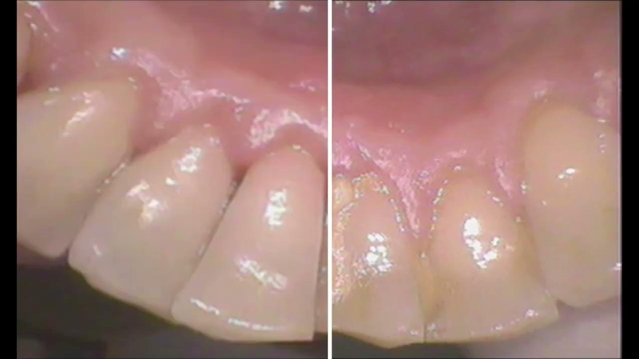 Clean Before and After at Mint Dental Hygiene, Takapuna. Treatment by