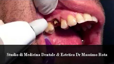 Quale la radice del dente?