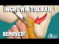 What Does an Ingrown Toenail Look Like? Dr. Nick Campitelli