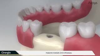 Como É Feito O Implante