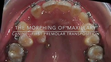 The morphing of Maxillary Canine First Premolar Transposition