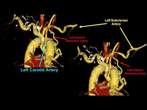 Video: Relație Structural-vascular-funcțională Retinală Folosind Tomografie De Coerență Optică și Tomografie De Coerență Optică - Angiografie în Miopie