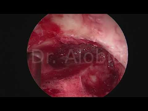 Frontal sinus surgery (Draf III)