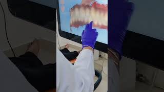 Itero Lumina Scanner For Invisalign....