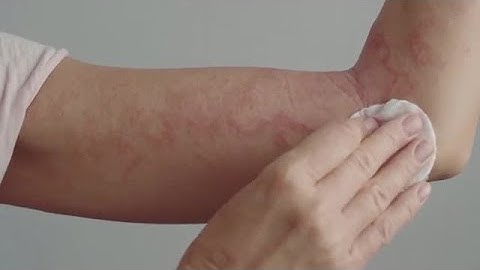 Treating A Rash Stock Video