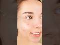 Confused between salicylic acid and niacinamide????#brightskin #acnetreatment