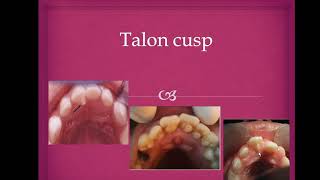 what is Talon cusp(mfds,mjdf,Bds)
