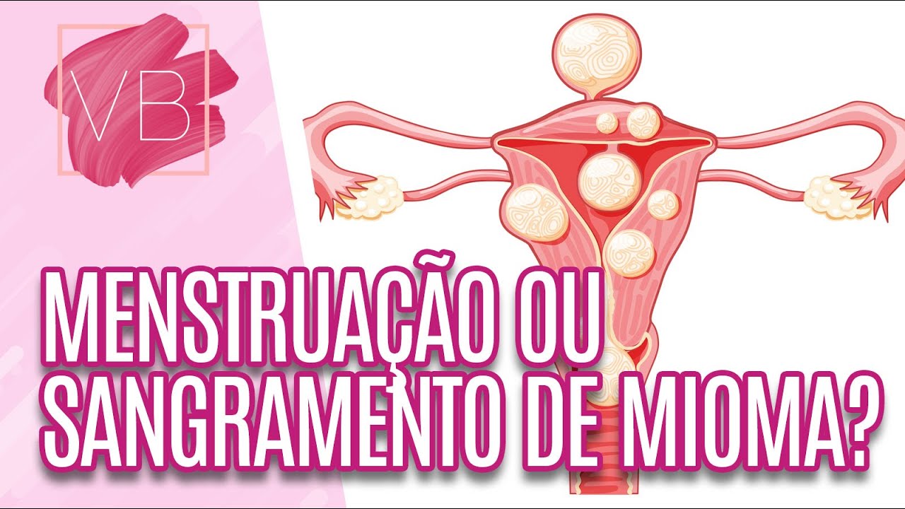 Sangramento em excesso na menstruação pode ser mioma; entenda