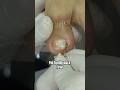 O Caso Mais Doloroso do Ano: Unha Encravada + Alergia Grave #satisfying #nails
