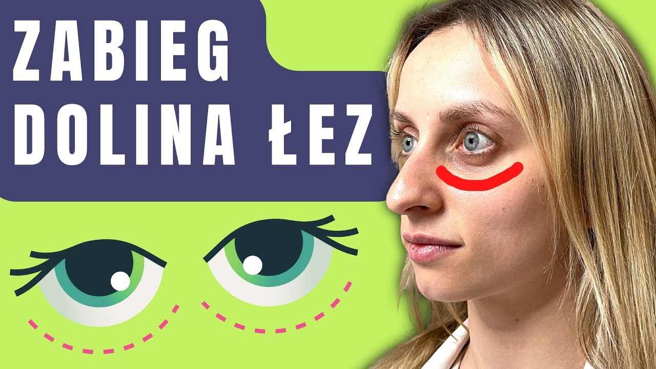 ❗️Dolina Łez: Wypełnienie Kwasem Hialuronowym. CAŁY ZABIEG!