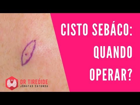 Vídeo: Cisto Mediano Do Pescoço: Tratamento, Cirurgia, Sintomas, Causas, Foto