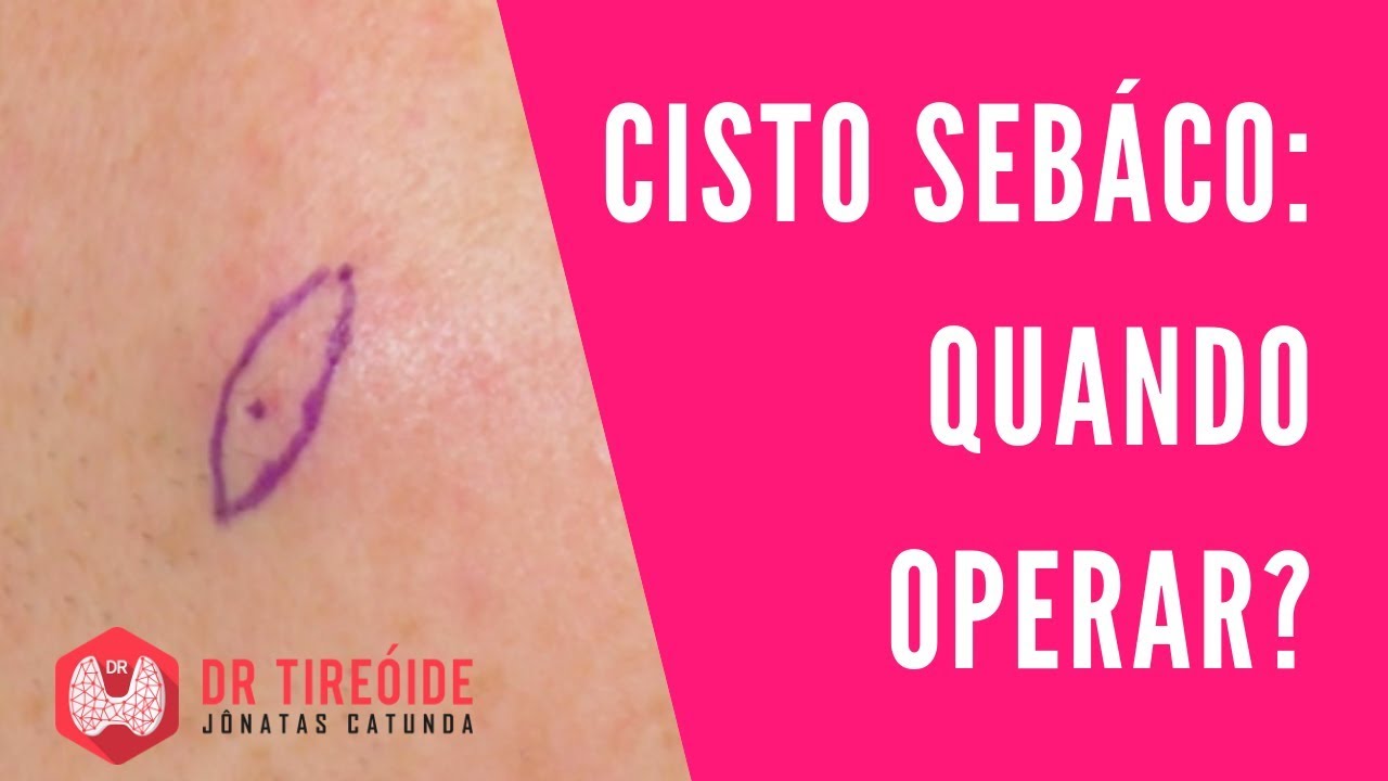 pomada para cisto sebáceo no rosto
