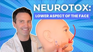 Neurotoxins: Lower Aspect of the Face