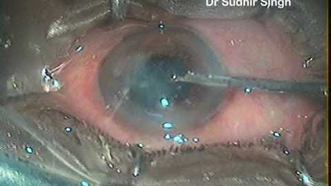 Irrigation and Aspiration using Simcoe Canula in Phaco