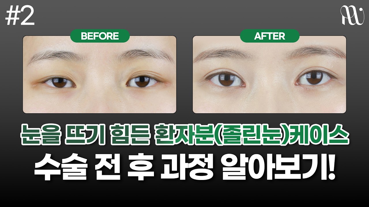 눈뜨기 힘든 졸린눈, 수술 전후 과정 알아보기!