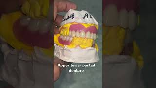Upper lower partial denture 😬😬😬#splittooth #apexdental #orthodontist #dentistry #partialdenture