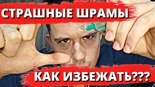 Грубые рубцы (шрамы) | Как избежать | Лечение рубцов