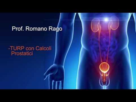 calcoli nella prostata e nella vescica ray la