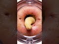 INSIDE The Pore: Microscope Vacuum Camera Removal (1000x Zoom) #satisfying #Endoscope #MicroscopeASM
