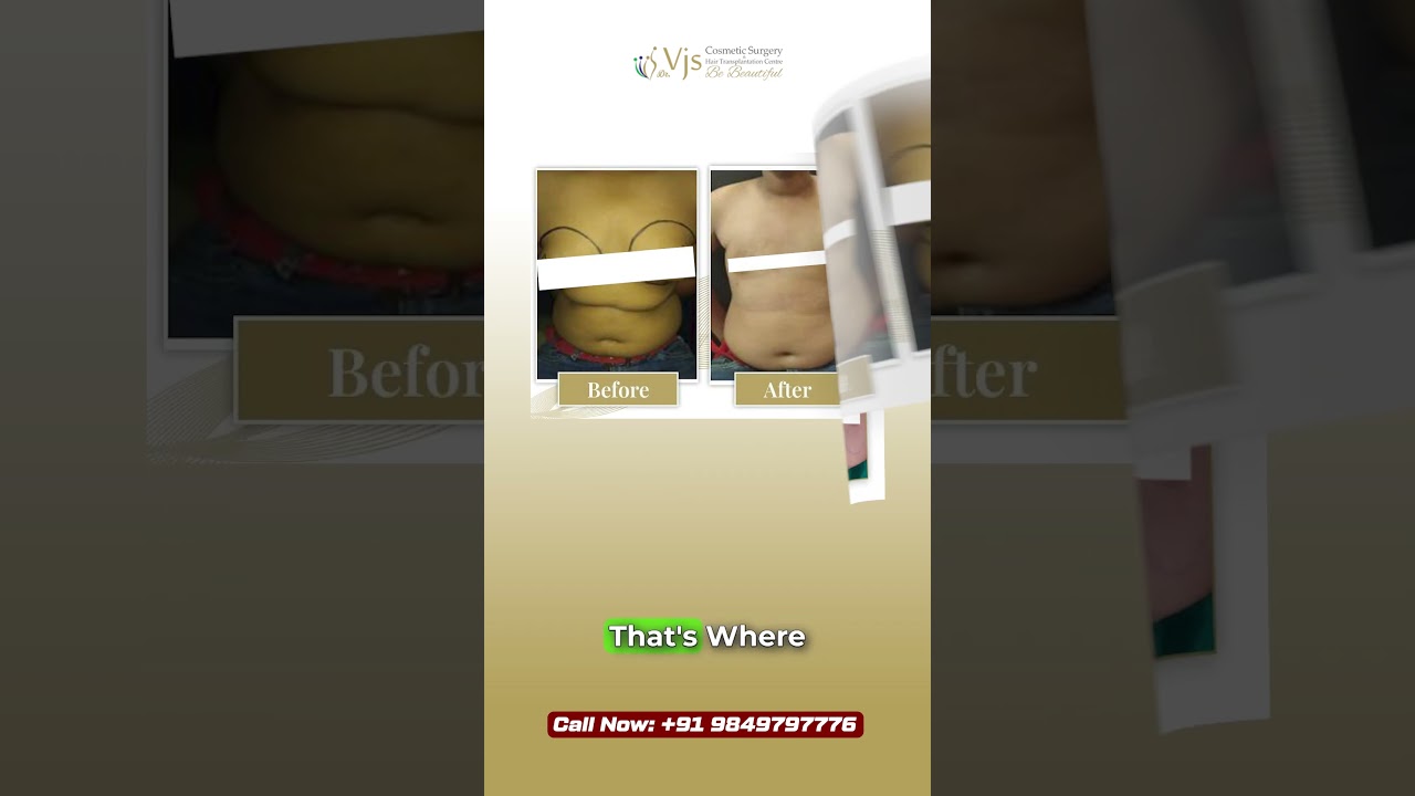 Still Hiding Your Chest? | Gynecomastia Surgery Andhra Pradesh | The Confidence Change Men Want