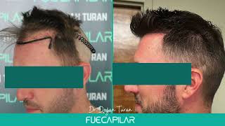 Dhi Hair Transplant 3915 Grafts Nw Iv By Dr Turan - Fuecapilar, Istanbul, Turkey