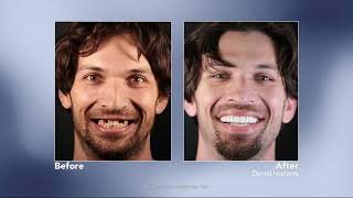 Replacing Missing Teeth with Dental Implants with Shawn Keller, DDS | Redmond, WA Dentist