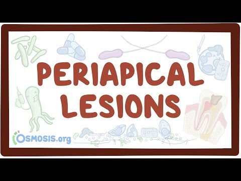 Periapical lesions - causes, symptoms, diagnosis, treatment, pathology