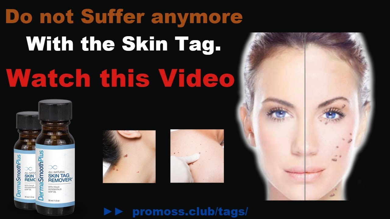 how to get rid of skin tags and moles - YouTube