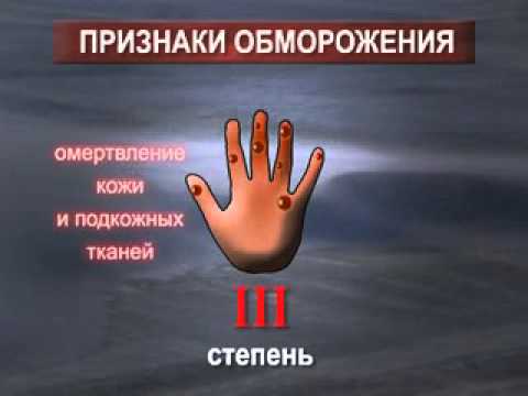 Обморожение