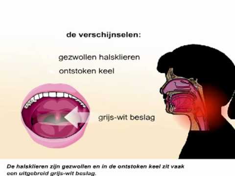 Video: Angina - Differentiële Diagnose Van Angina En Difterie