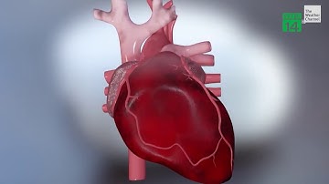 Rủi ro bệnh tim mạch trong dịch covid-19 | VTC14